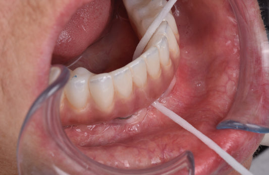 How to Clean Under an All-on-4 Bridge at Home